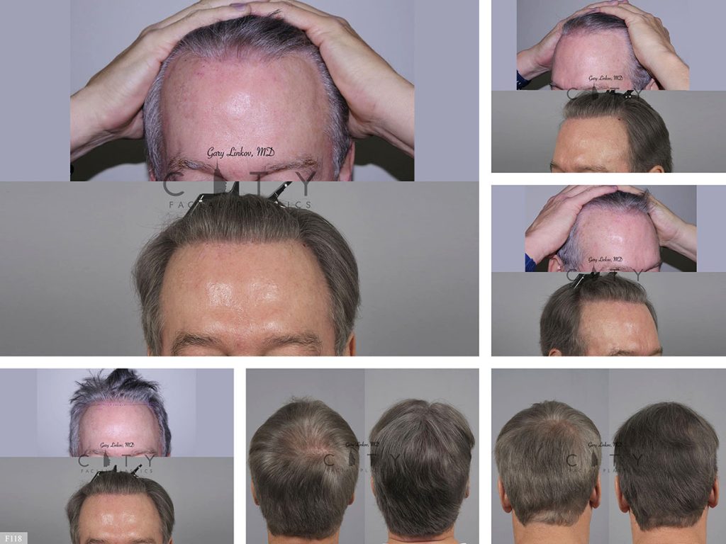 Hair Transplant F118