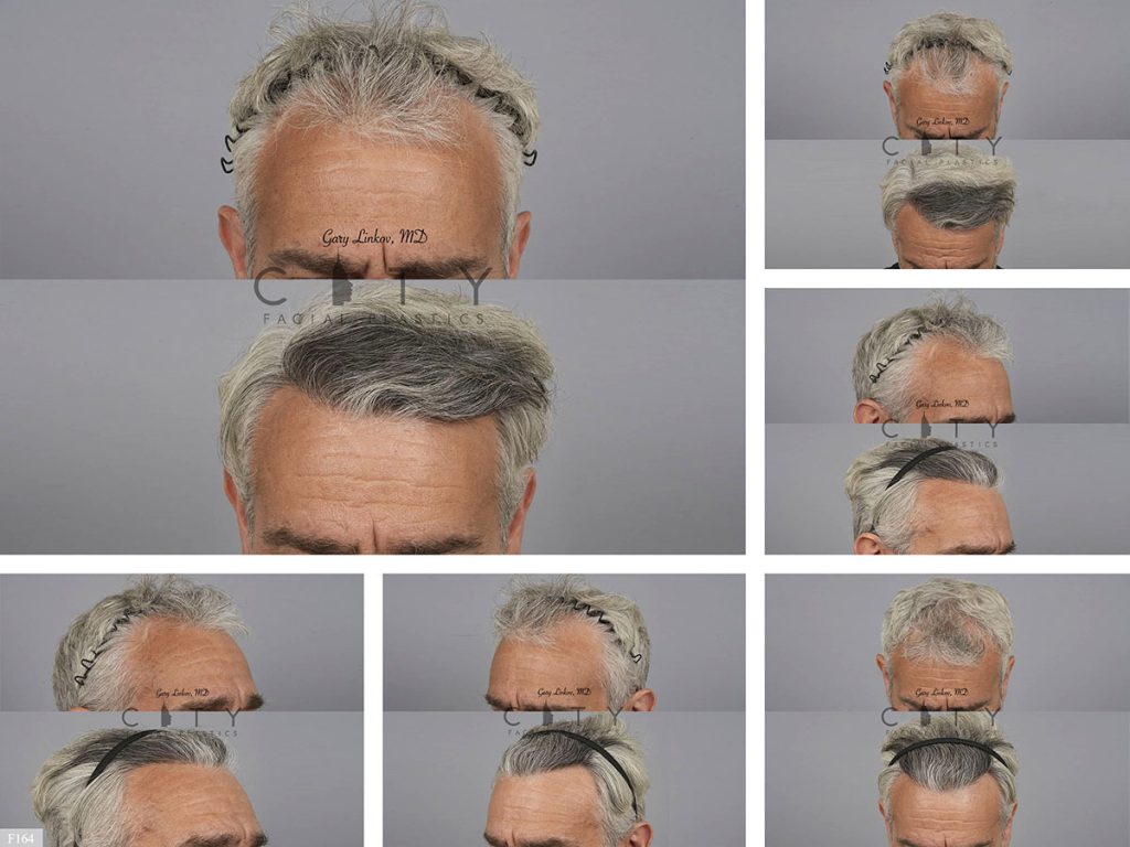 Hair Transplant F164