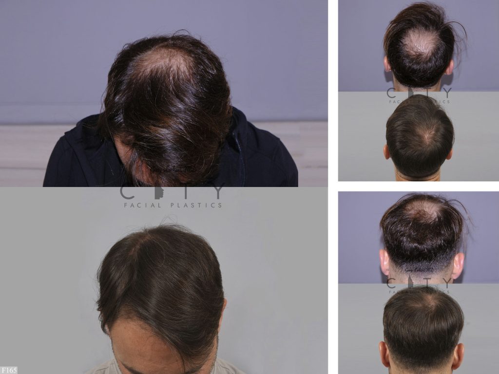 Hair Transplant F165
