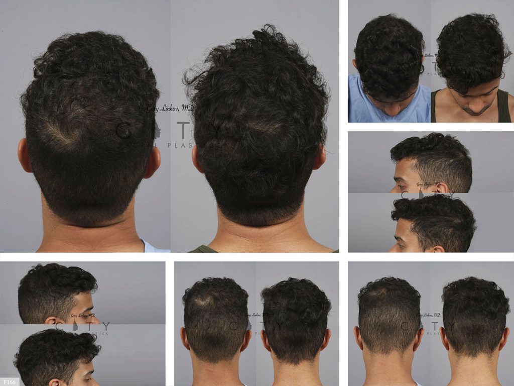 Hair Transplant F166