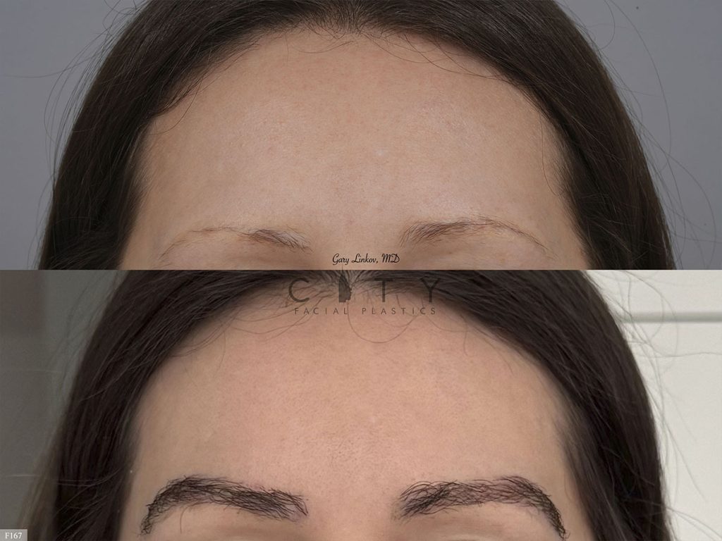 Hair Transplant F167