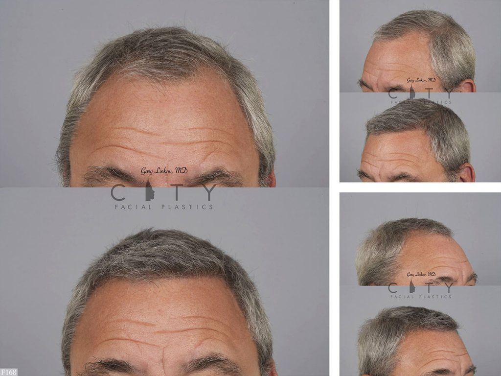 Hair Transplant F168
