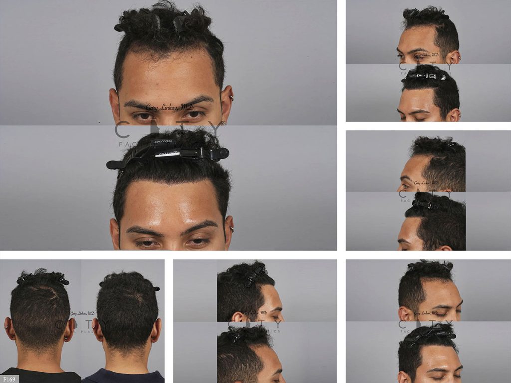 Hair Transplant F169