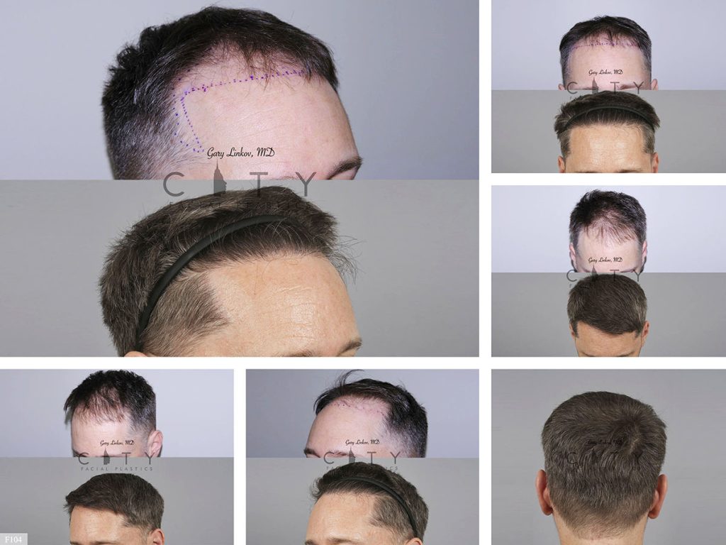Hair Transplant F104