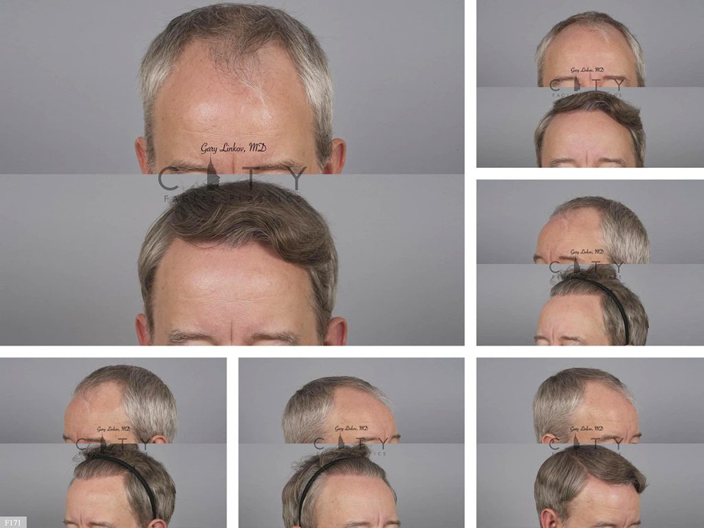 Hair Transplant F171