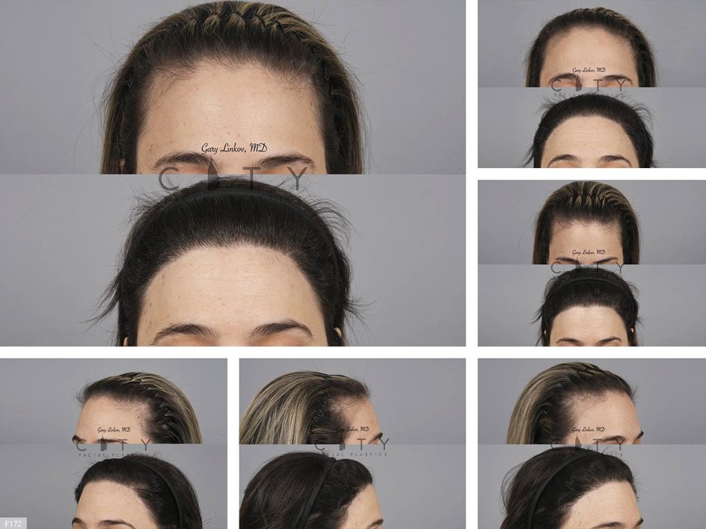 Hair Transplant F172