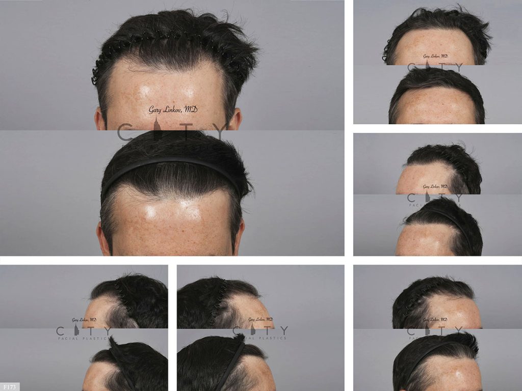 Hair Transplant F173
