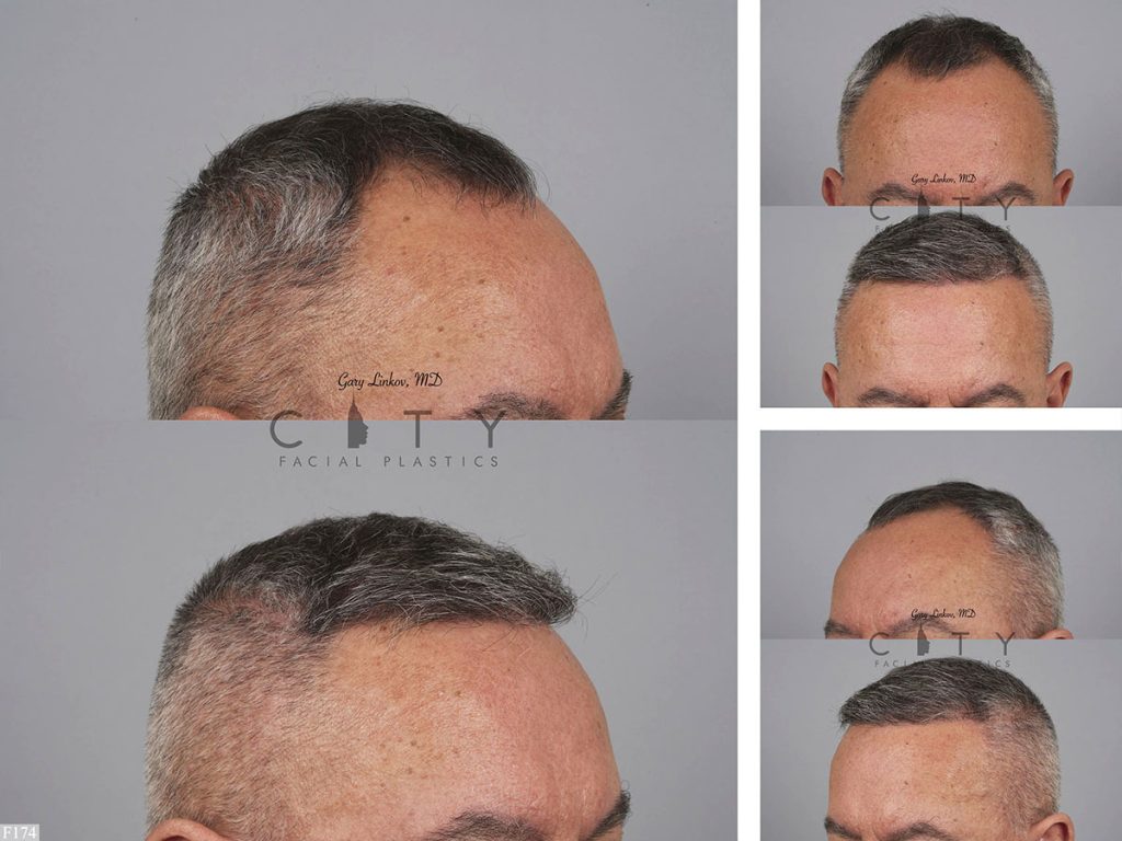 Hair Transplant F174