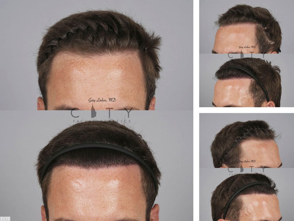 Hair Transplant F175