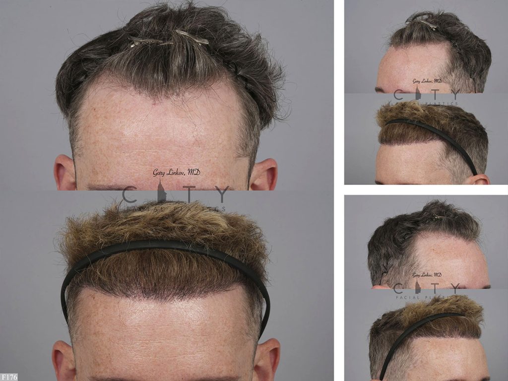 Hair Transplant F176