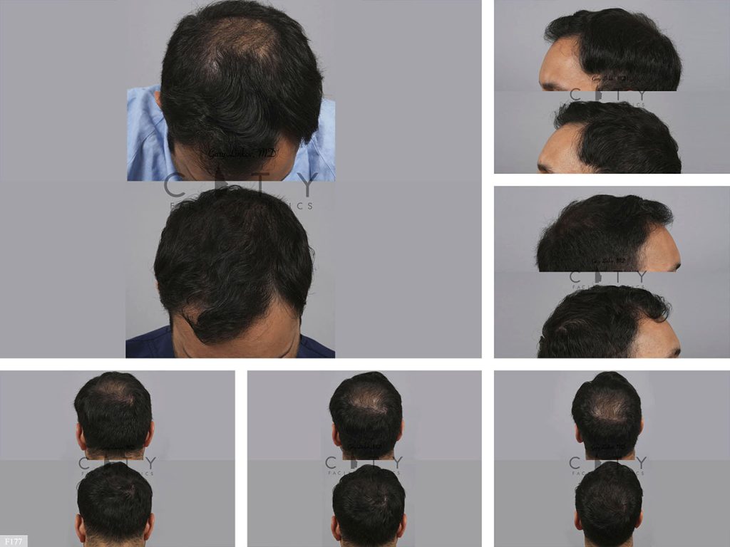 Hair Transplant F177