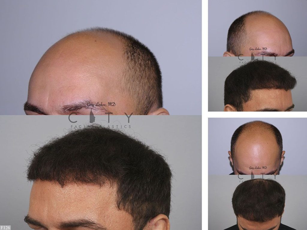 Hair Transplant F126