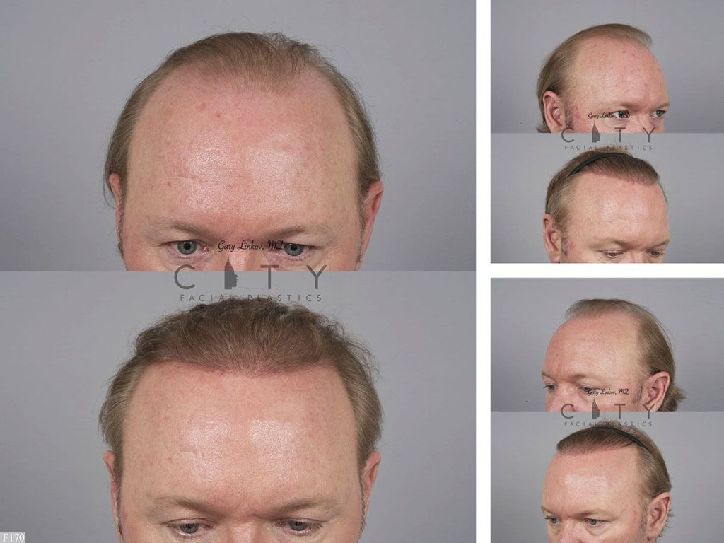 Hair Transplant F170