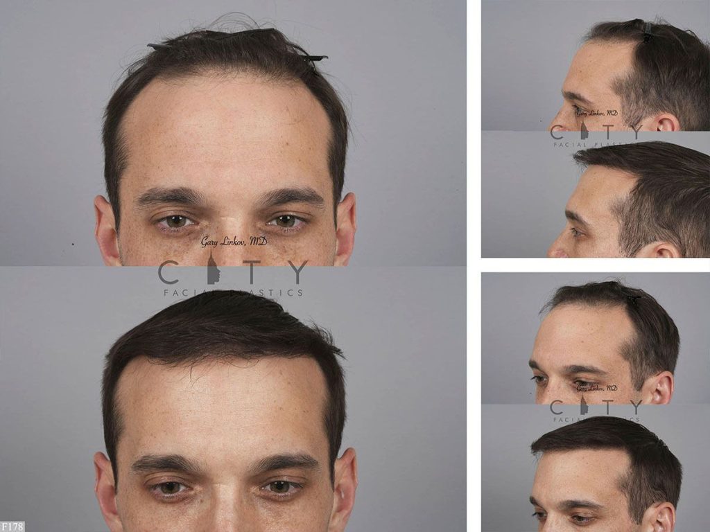 Hair Transplant F178