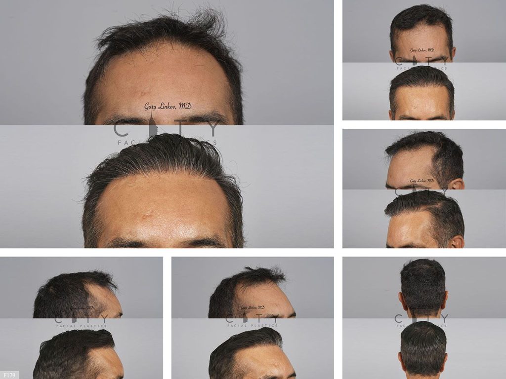 Hair Transplant F179