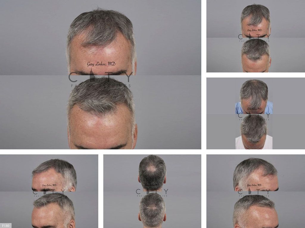Hair Transplant F180