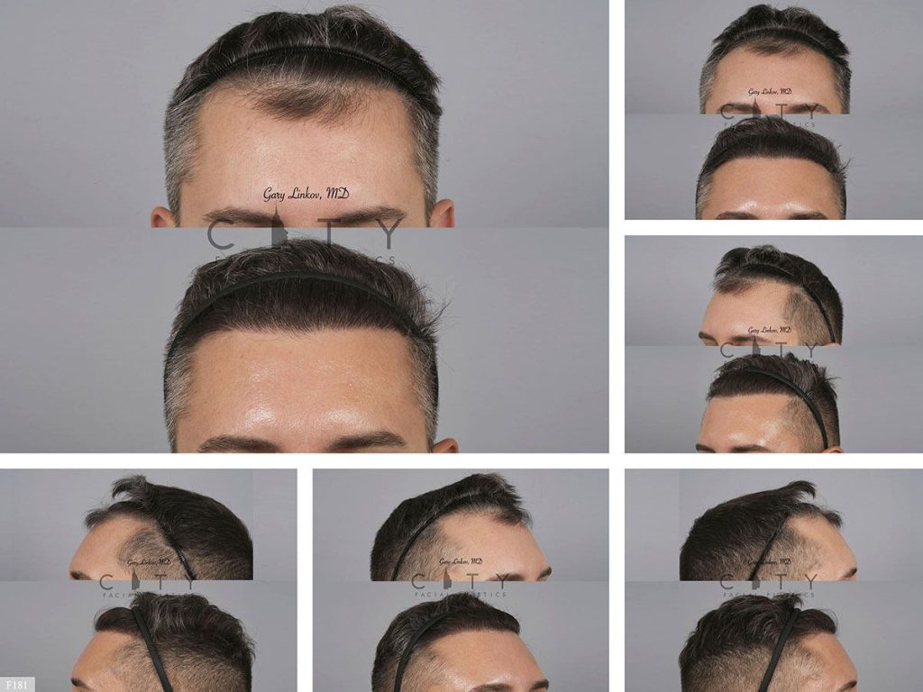 Hair Transplant F181