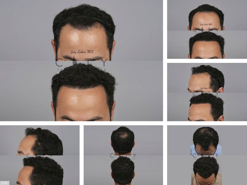 Hair Transplant F182