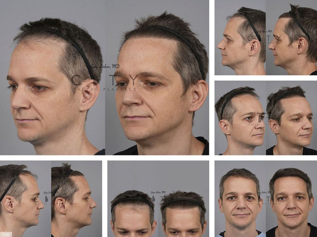 Hair Transplant F184