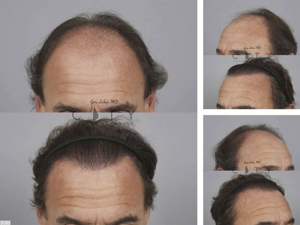 Hair Transplant F185