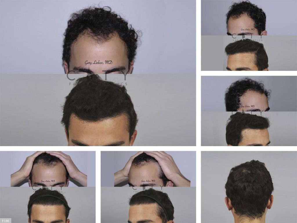 Hair Transplant F186