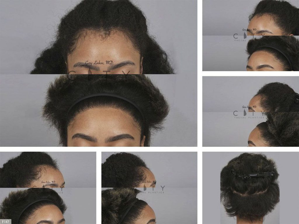 Hair Transplant F187