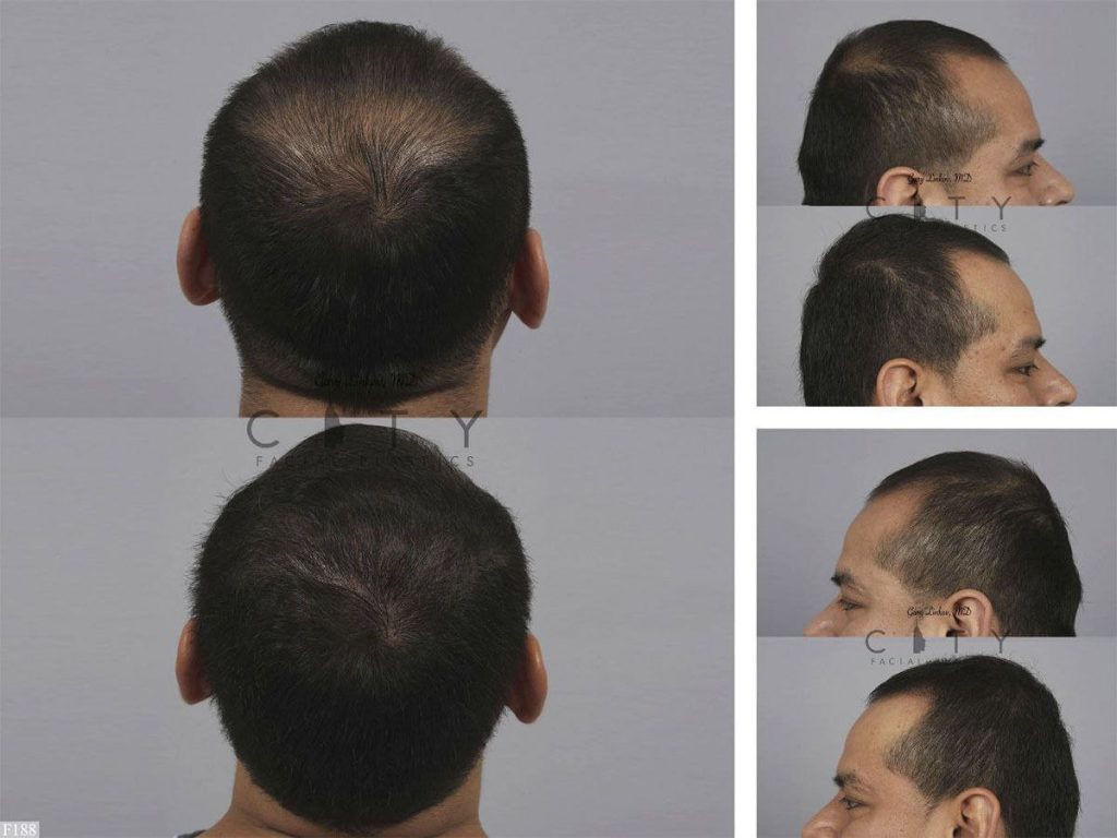 Hair Transplant F188