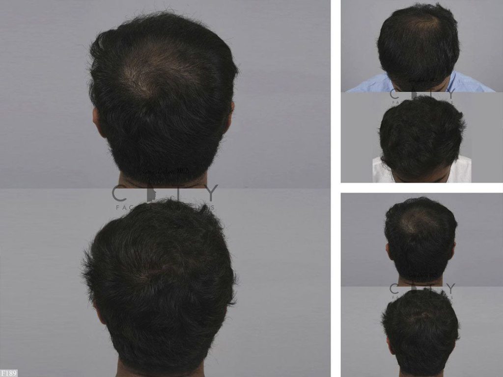 Hair Transplant F189