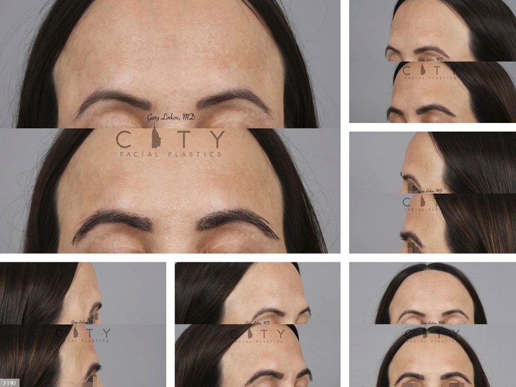 Hair Transplant F190