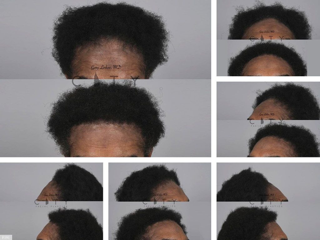 Hair Transplant F191