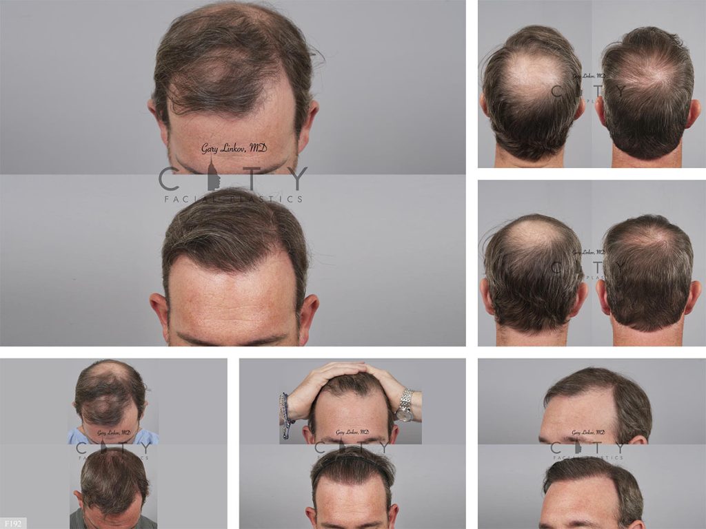 Hair Transplant F192