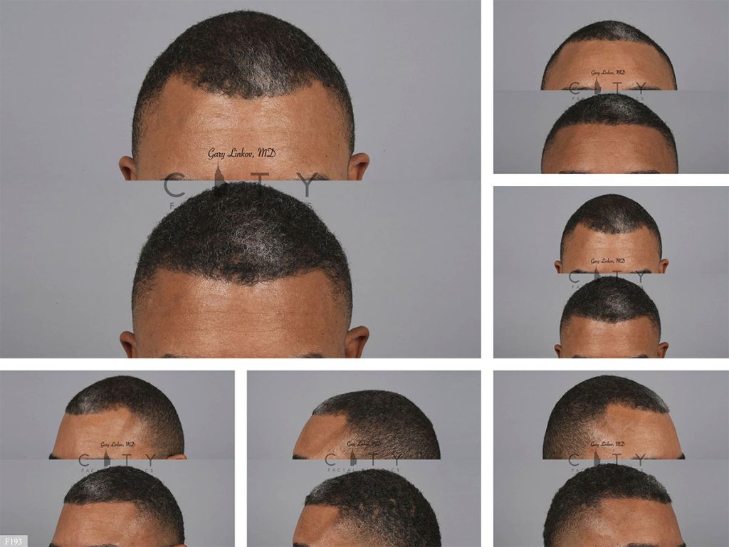 Hair Transplant F193