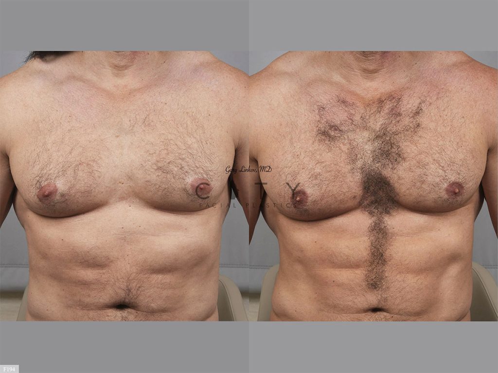 Hair Transplant F194