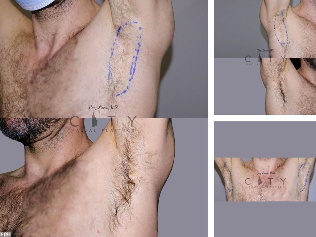 Hair Transplant F195