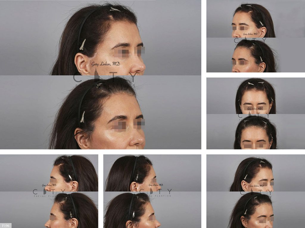 Hair Transplant F196