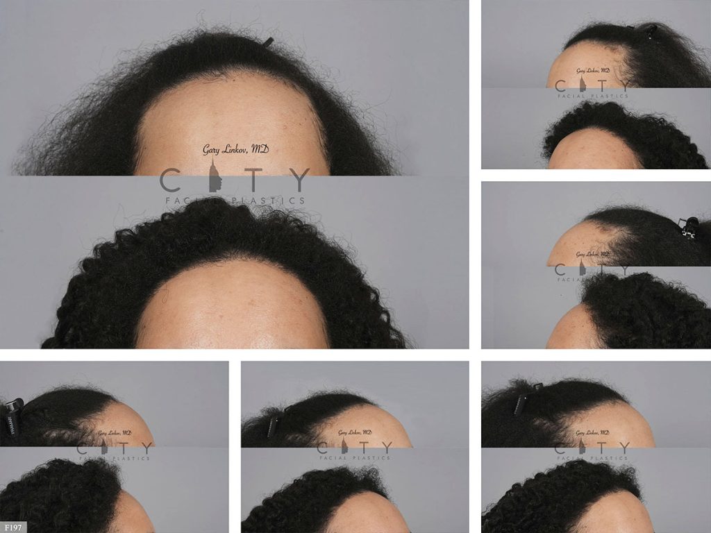 Hair Transplant F197