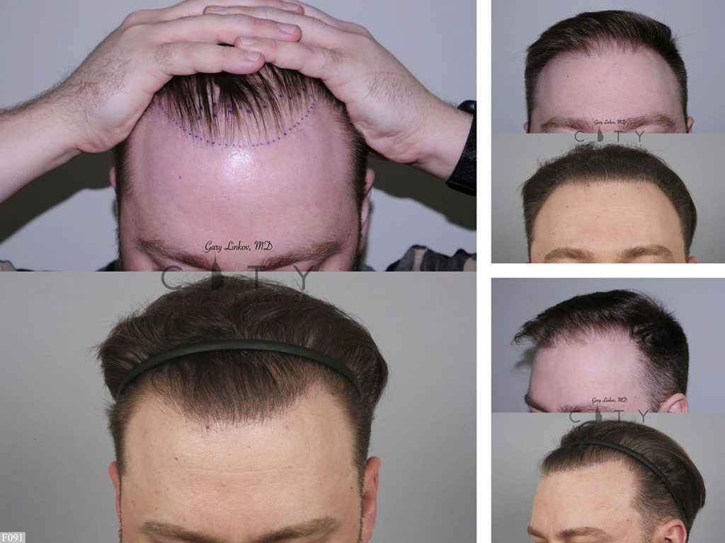 Hair Transplant F091