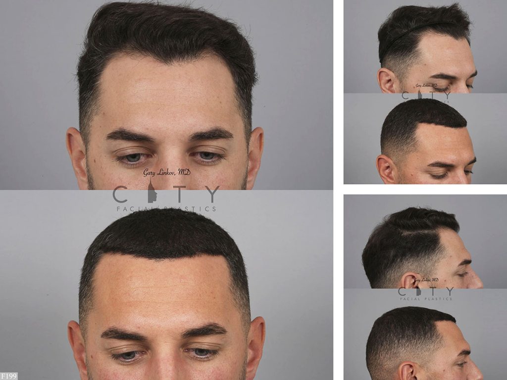 Hair Transplant F199