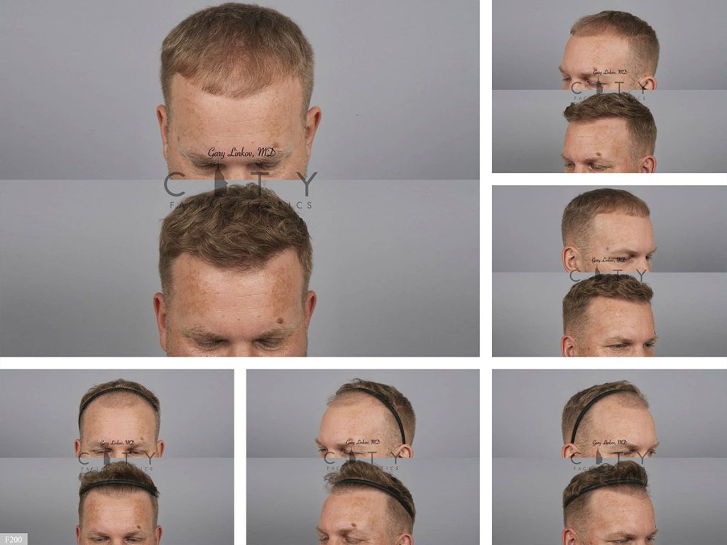 Hair Transplant F200