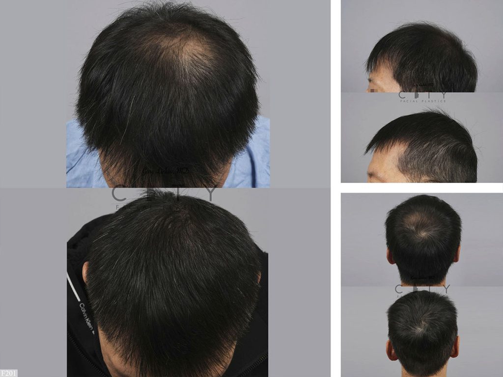 Hair Transplant F201