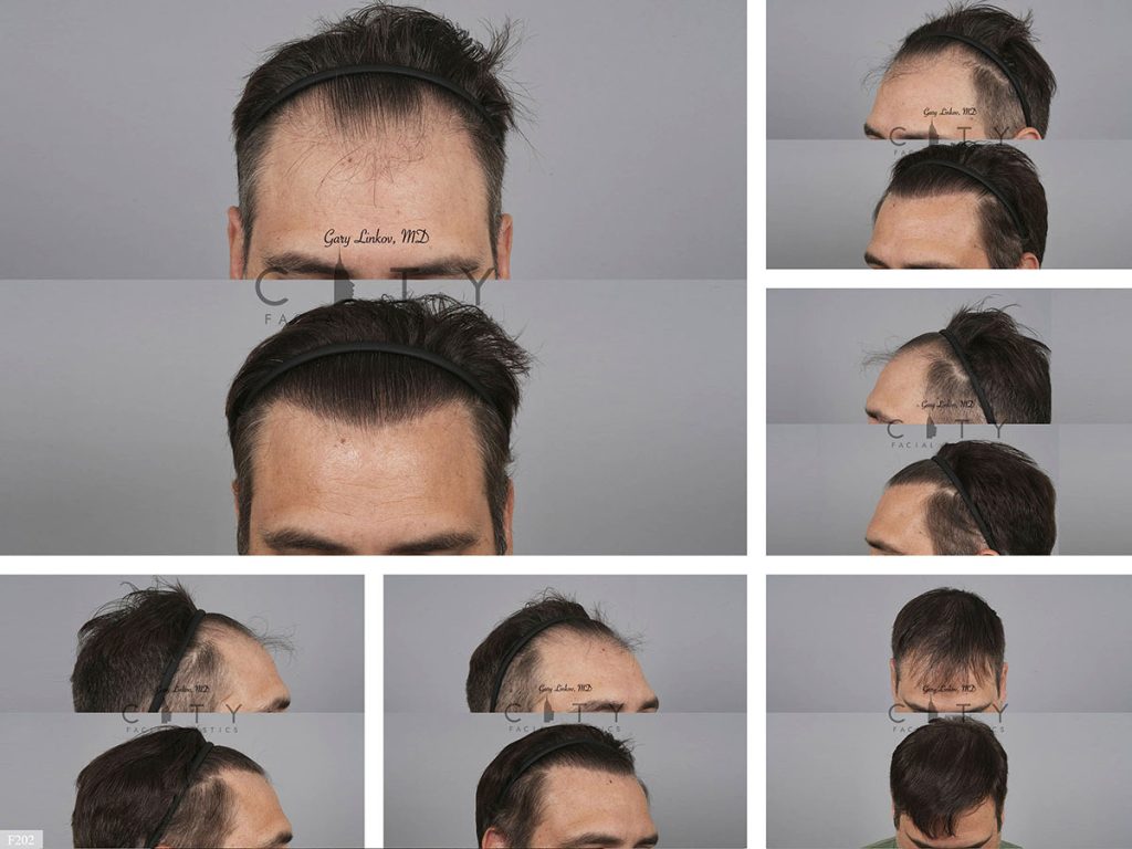 Hair Transplant F202