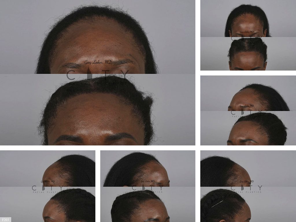 Hair Transplant F203