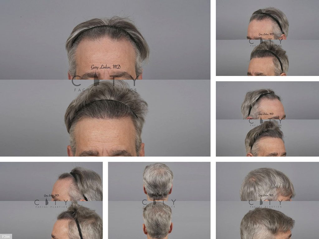 Hair Transplant F204