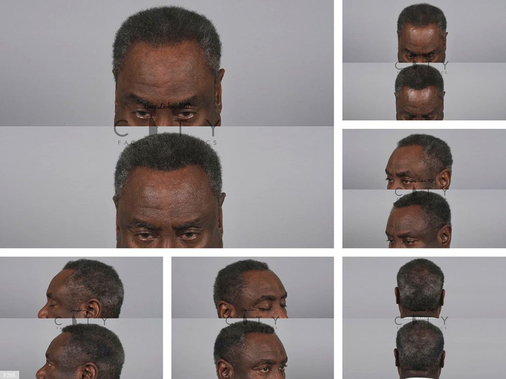 Hair Transplant F205