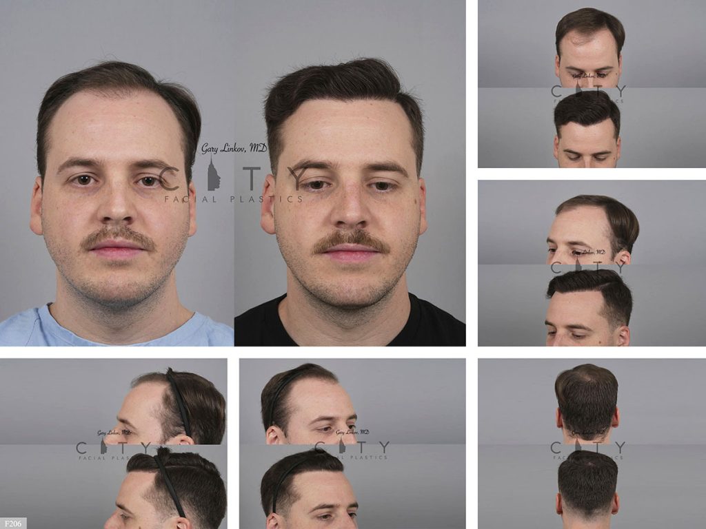 Hair Transplant F206