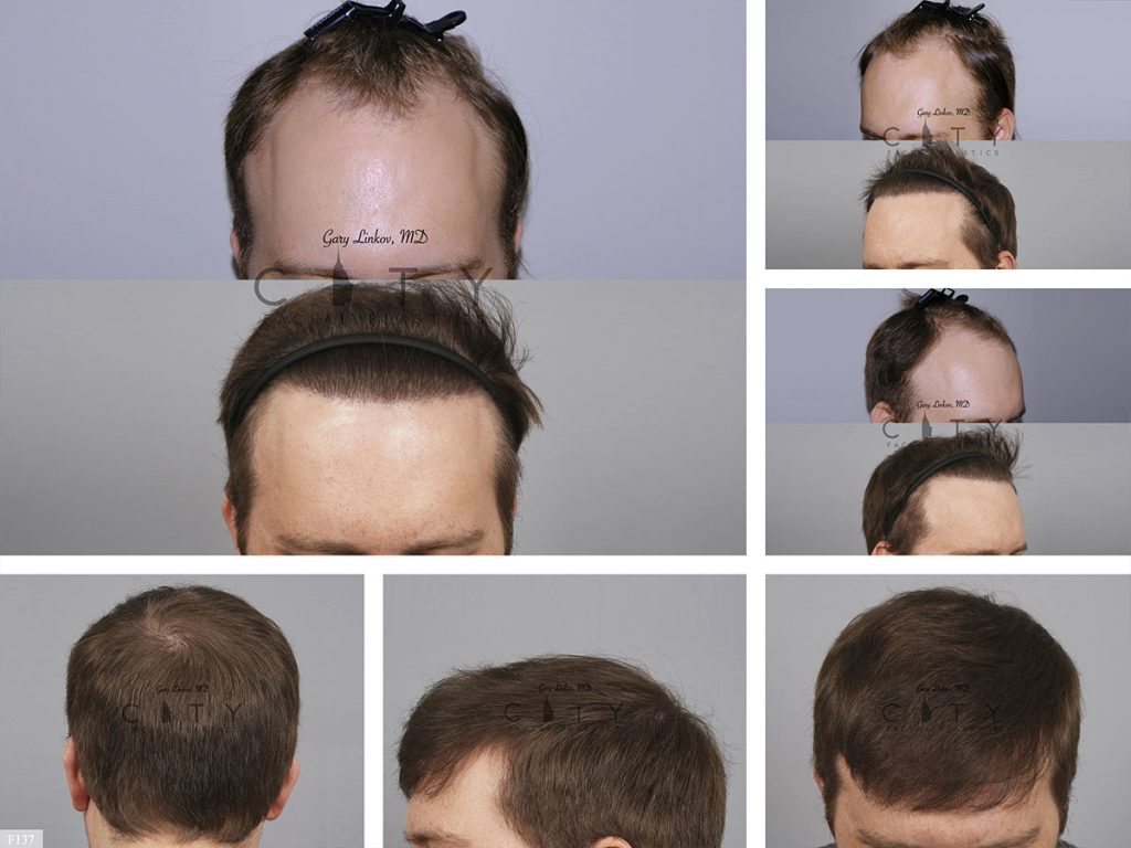 Hair Transplant F137