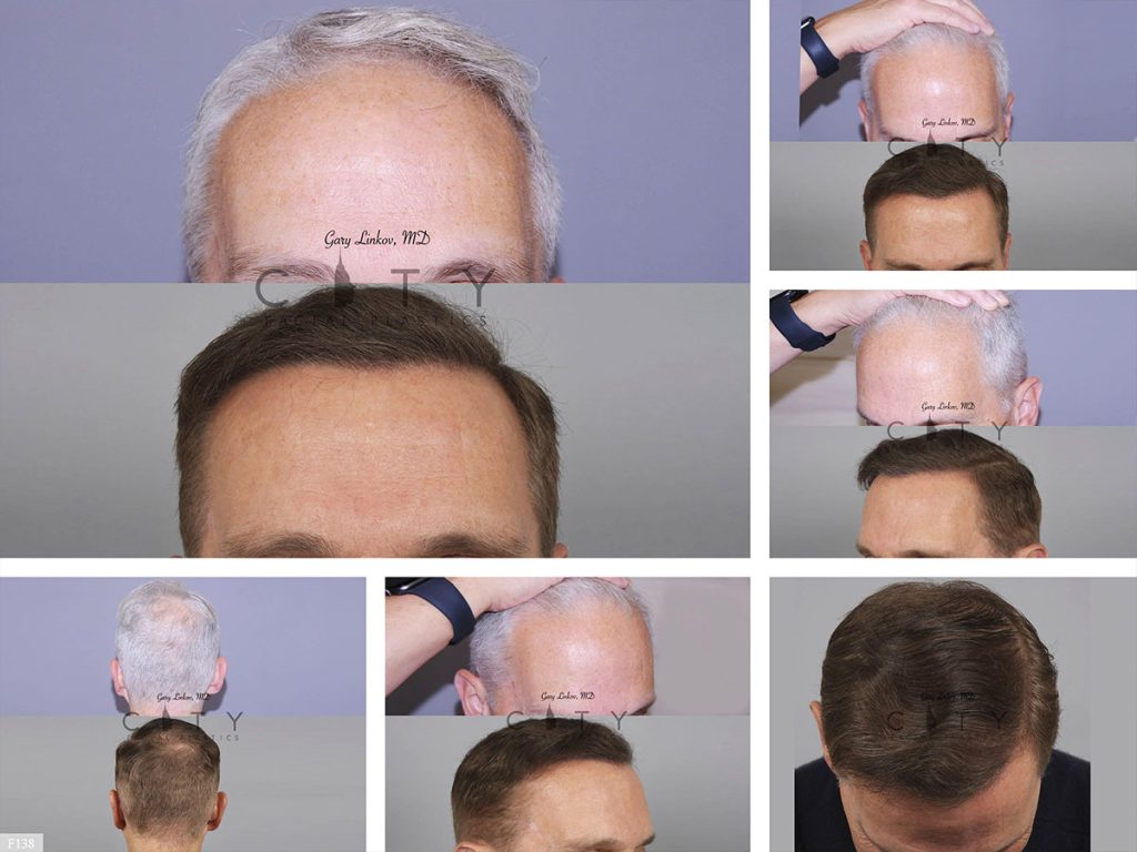 Hair Transplant F138