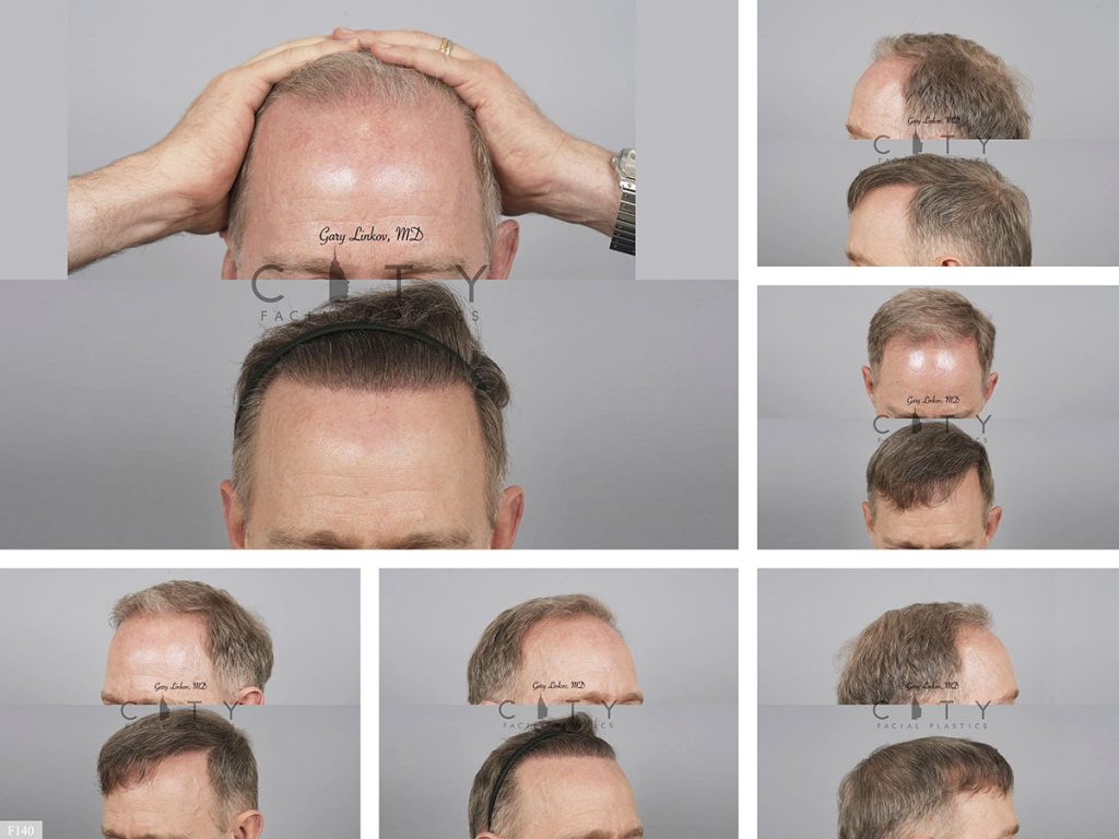 Hair Transplant F140