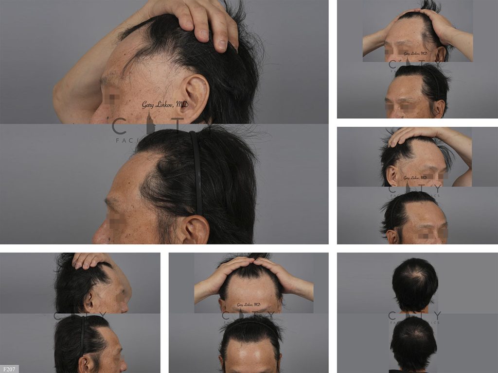 Hair Transplant F207