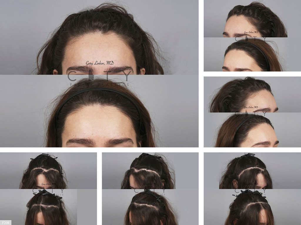 Hair Transplant F208